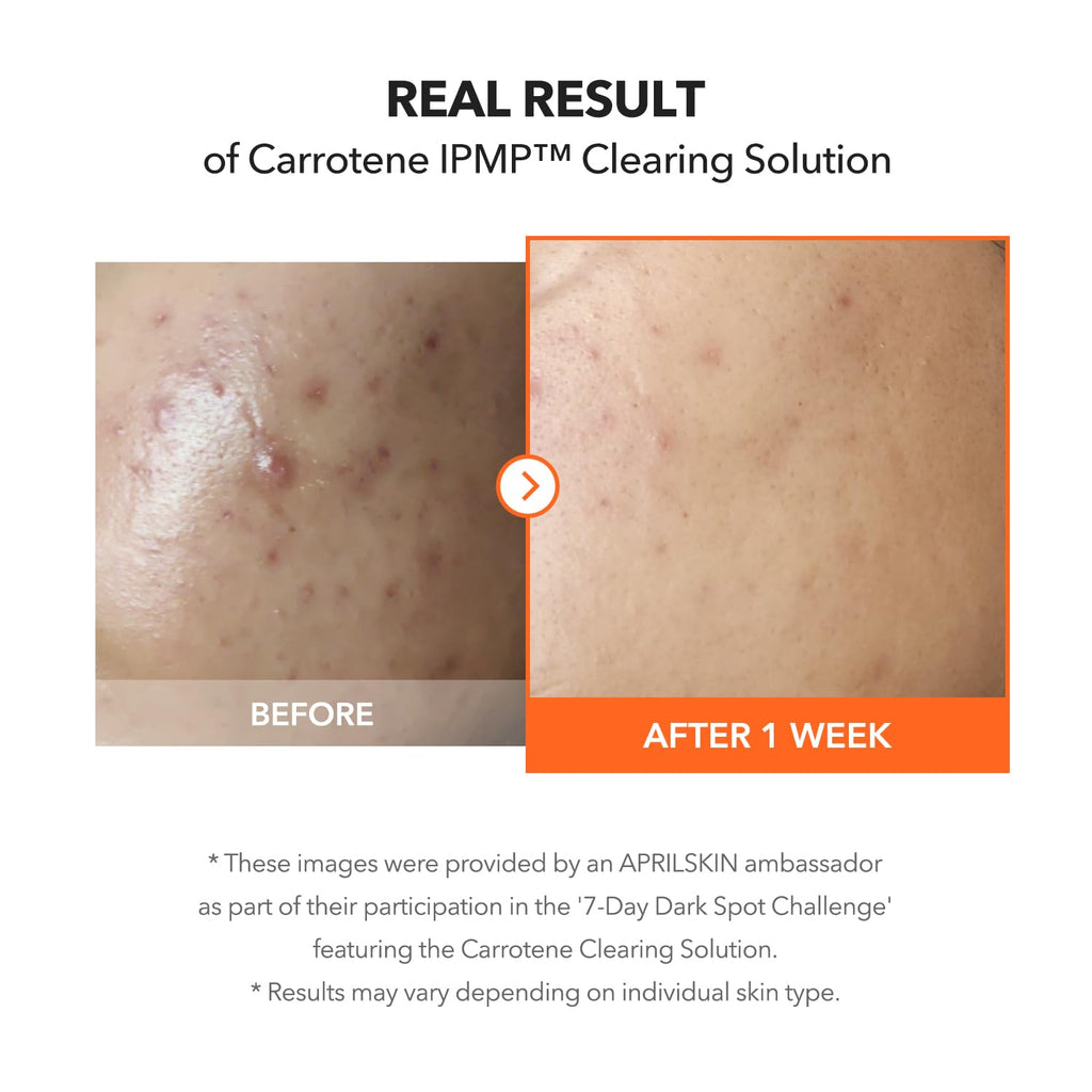 Soothe Acne & Blemishes with APRILSKIN Carrotene IPMP Clearing Gel - 5% Niacinamide, 1% Zinc Oxide