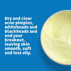 De La Cruz 10% Sulfur Ointment - Cystic Acne Treatment for Face & Body