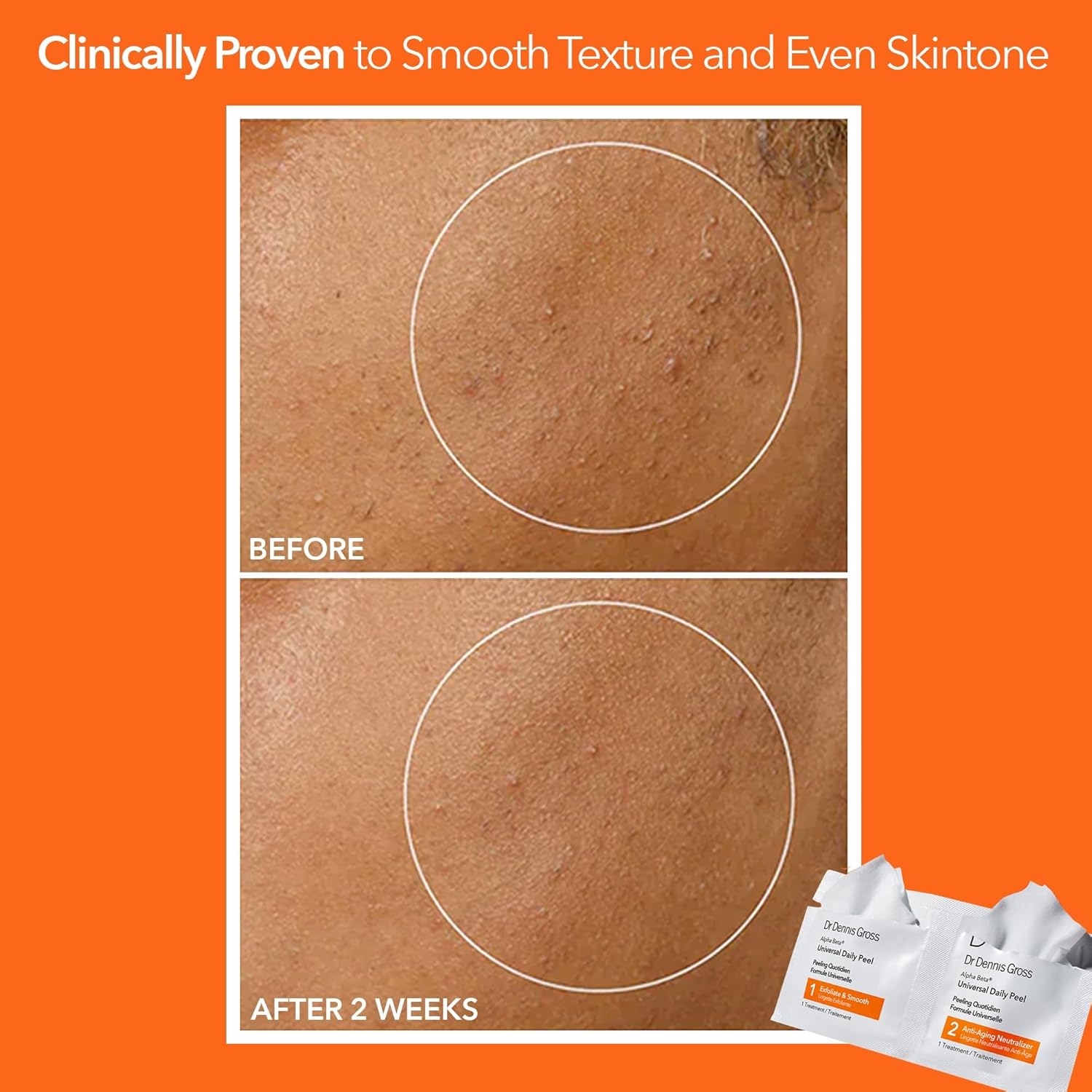 Dr Dennis Gross Alpha Beta Universal Daily Peel for Uneven Tone & Pores - 5 Treatments