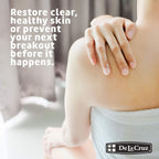 De La Cruz 10% Sulfur Ointment - Cystic Acne Treatment for Face & Body