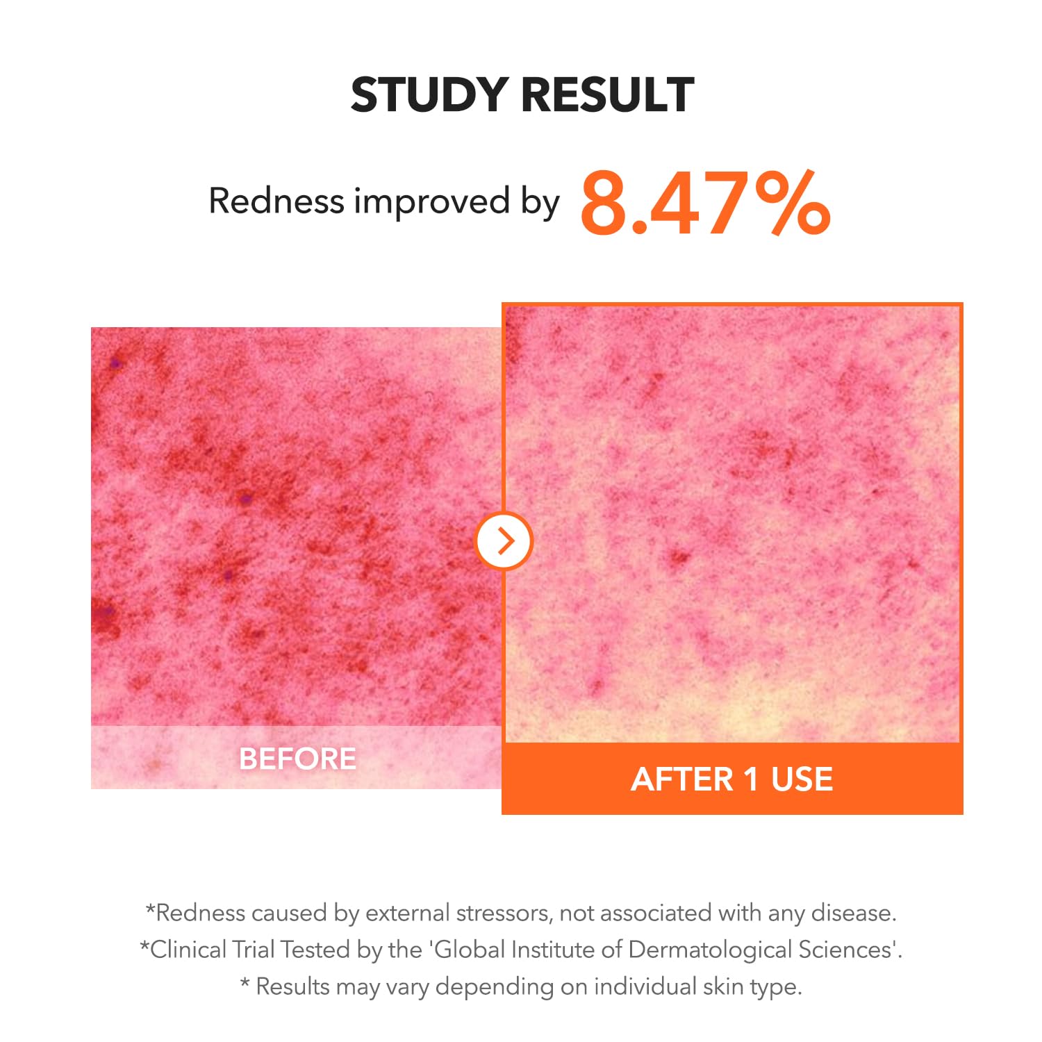 Soothe Acne & Blemishes with APRILSKIN Carrotene IPMP Clearing Gel - 5% Niacinamide, 1% Zinc Oxide