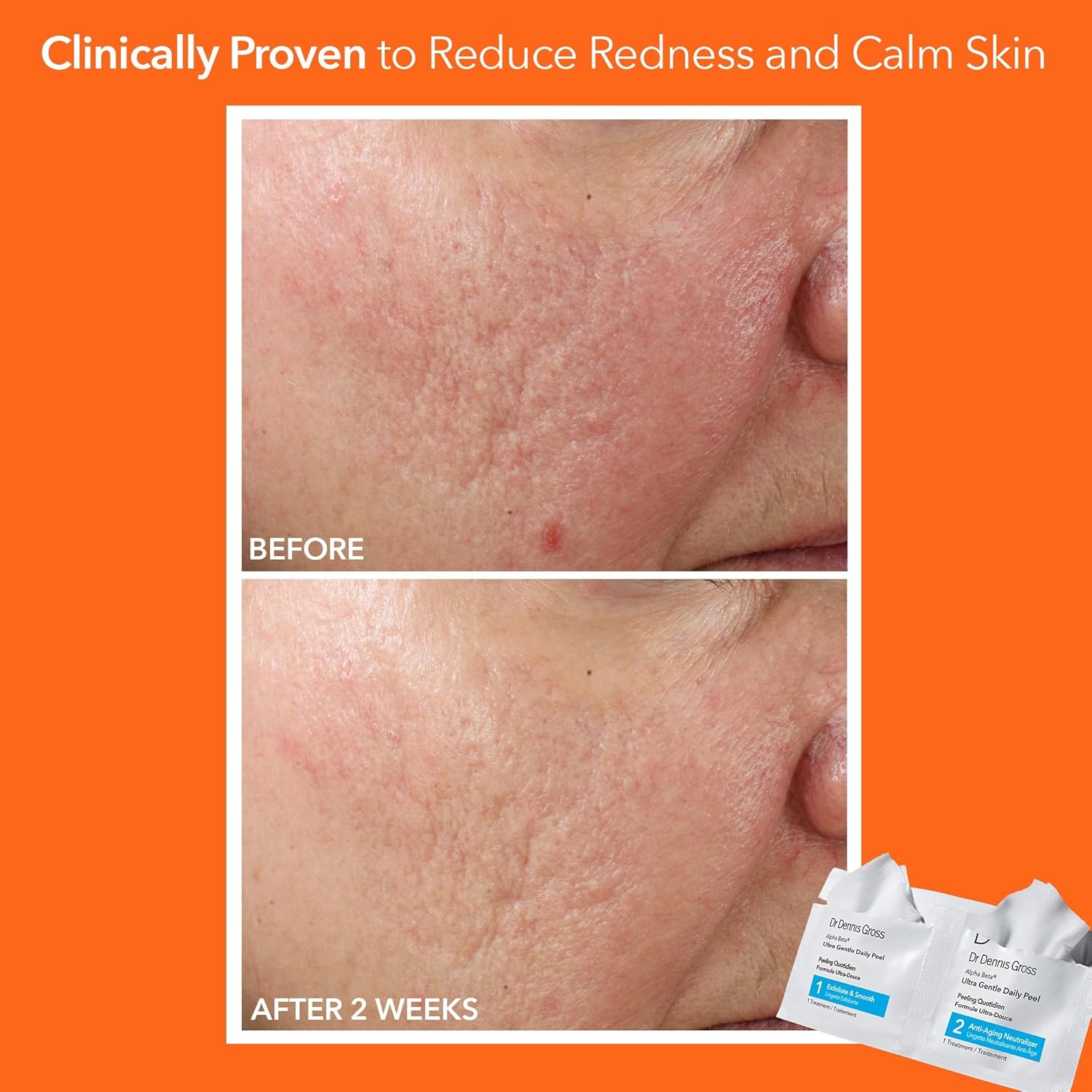 Dr. Dennis Gross Alpha Beta Ultra Gentle Daily Peel for Sensitive Skin - 5 Treatments