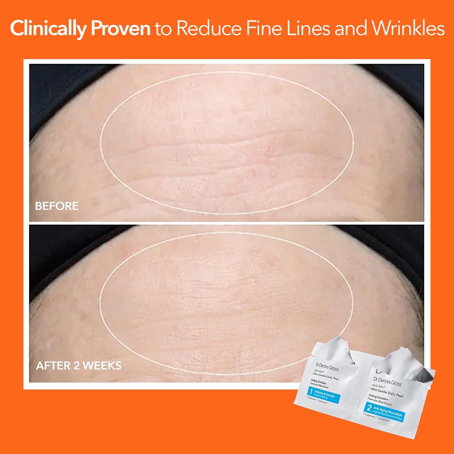 Dr. Dennis Gross Alpha Beta Ultra Gentle Daily Peel for Sensitive Skin - 5 Treatments