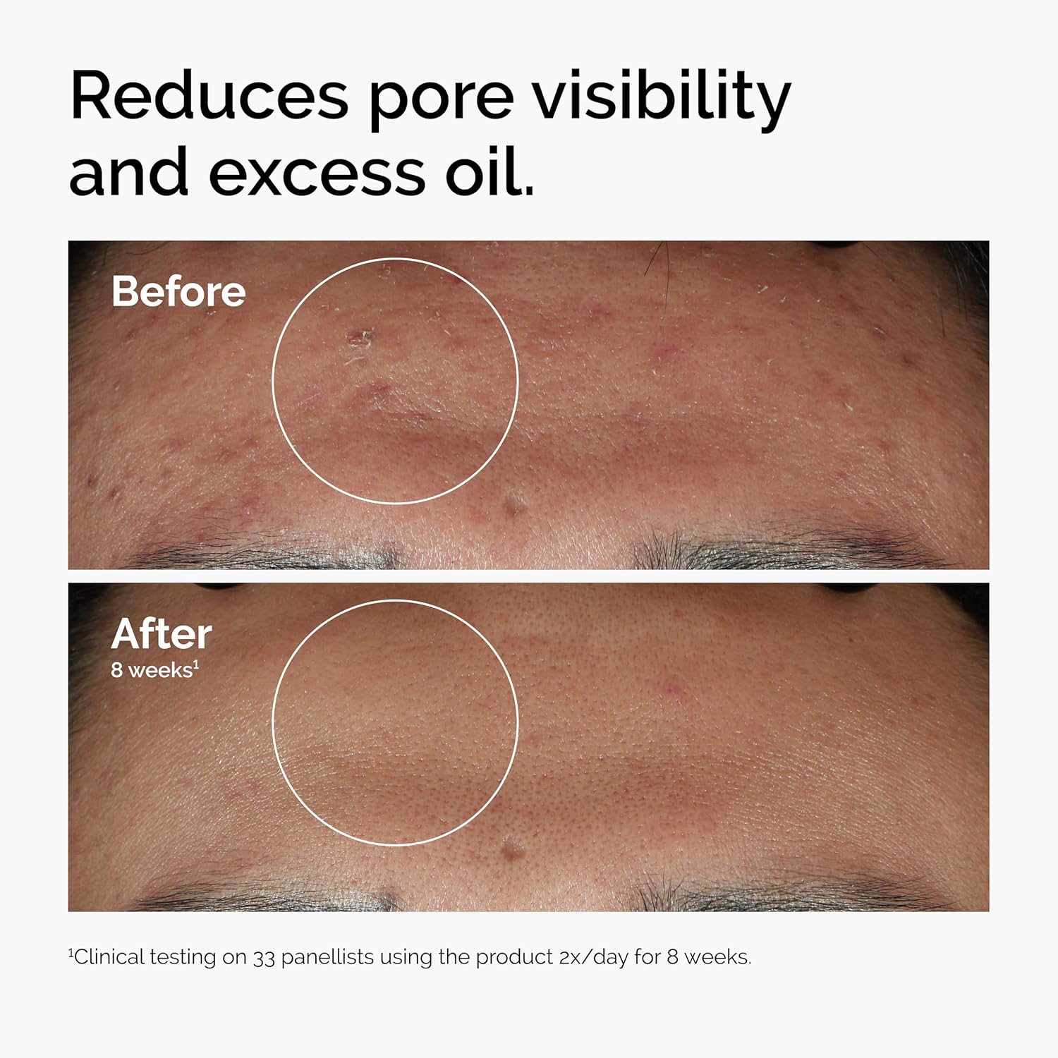 The Ordinary Niacinamide 10% + Zinc 1% Serum for Blemish-Prone Skin - Brightens & Smoothes in Weeks